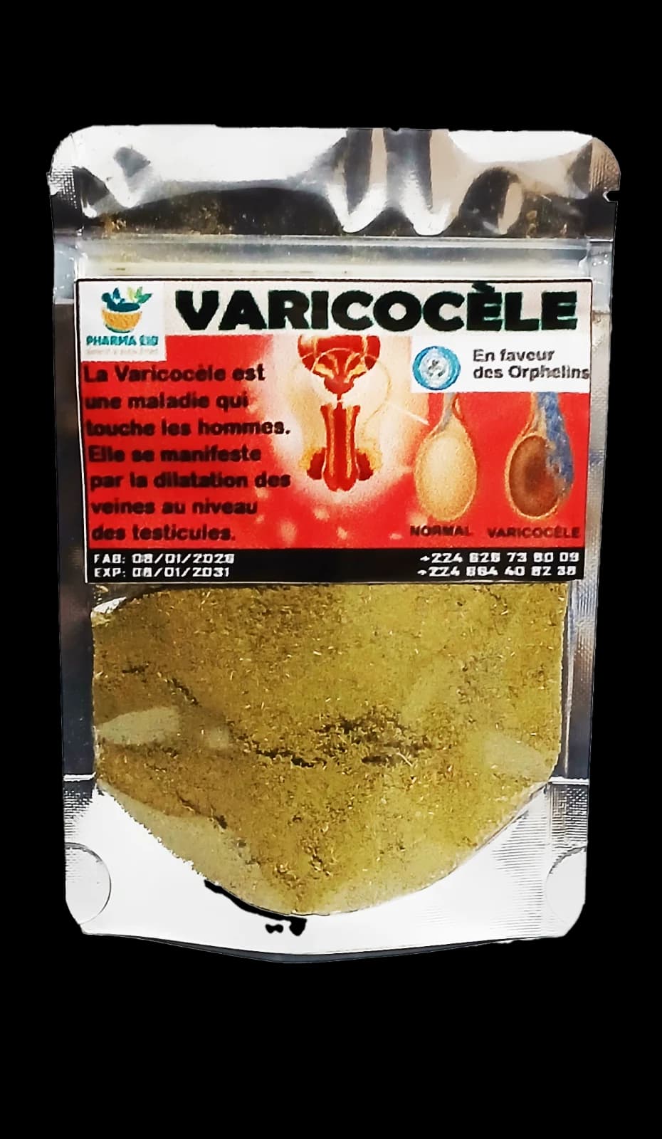 Varicocèle