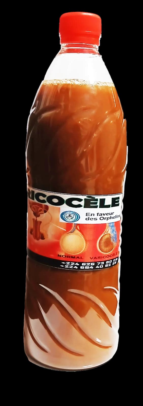 Varicocèle