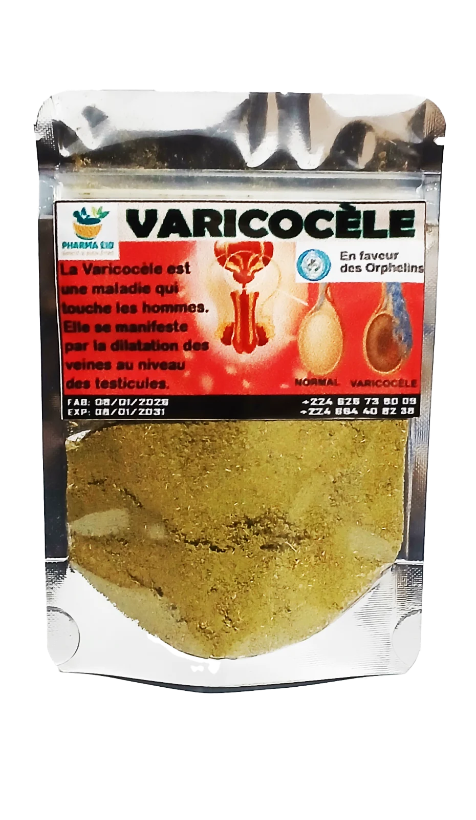 Varicocèle